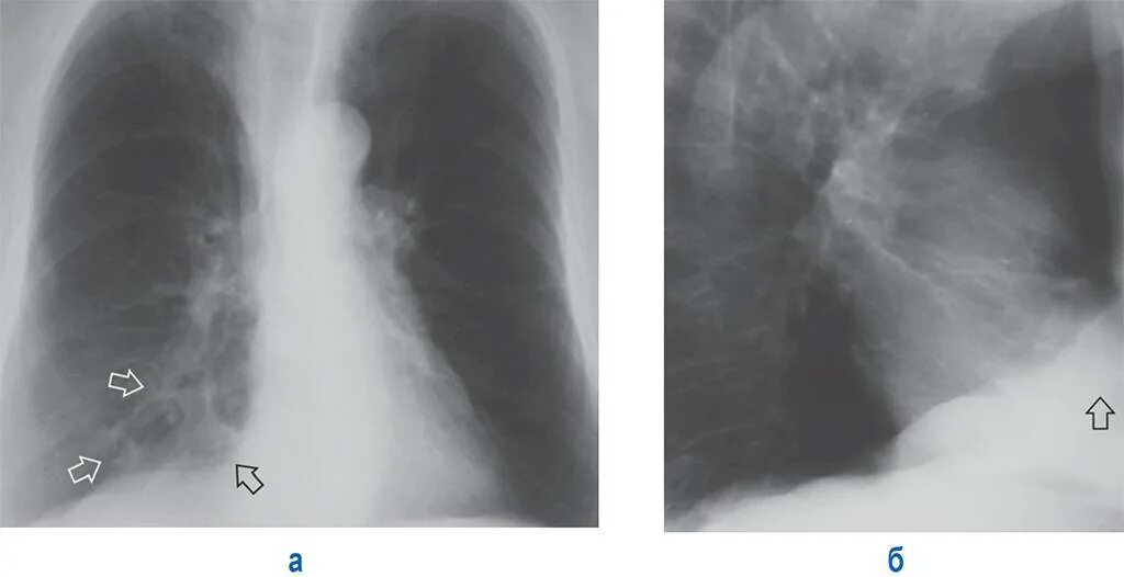 Пневмосклероз рентген. Легочный фиброз на рентгене. Посттуберкулезный пневмофиброз. Изменения базальных отделов легких