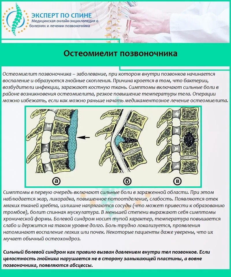 Боль в спине отеки. Ткани позвоночника. Остеомиелит поясничного отдела позвоночника. Нестабильность поясничного отдела позвоночника. Остеомиелит тел позвонков.