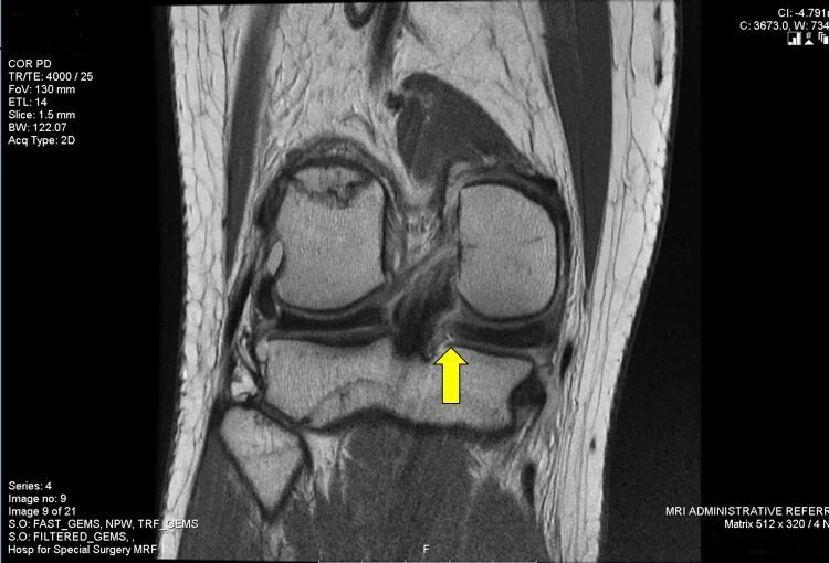 Мрт коленного сустава омс. Снимок мрт разрыв мениска. Повреждение мениска коленного сустава мрт.