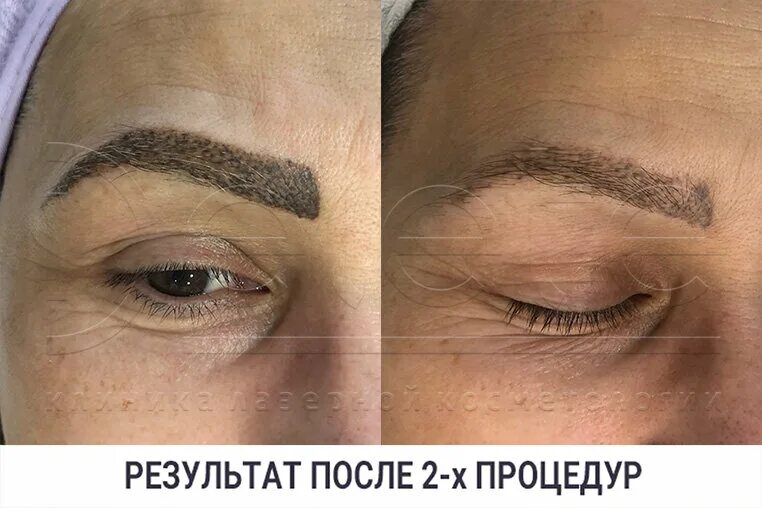 Удаление бровей лазером в Долгодеревенском: 65 исполнителей с отзывами и ценами 