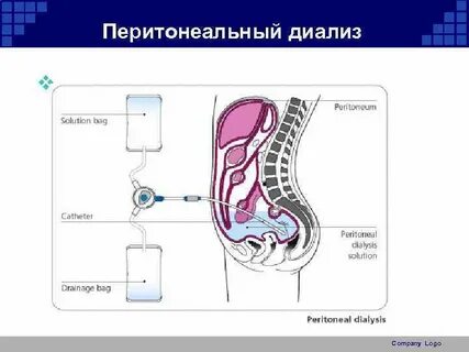 Перитонеальный