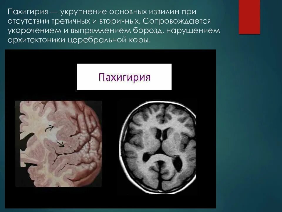 Пахигирия и полимикрогирия. Лиссэнцефалия-пахигирия. Пороки развития головного мозга мрт. Пахигария головного мозга. Нарушение развития головного мозга