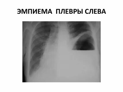 Пиоторакс с фистулой