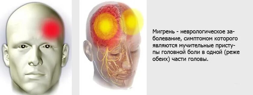 Сильная боль в лобной части. Болит голова. Головная боль мигрень. Мигренеподобные головные боли. Голова болела мигрень сильно.