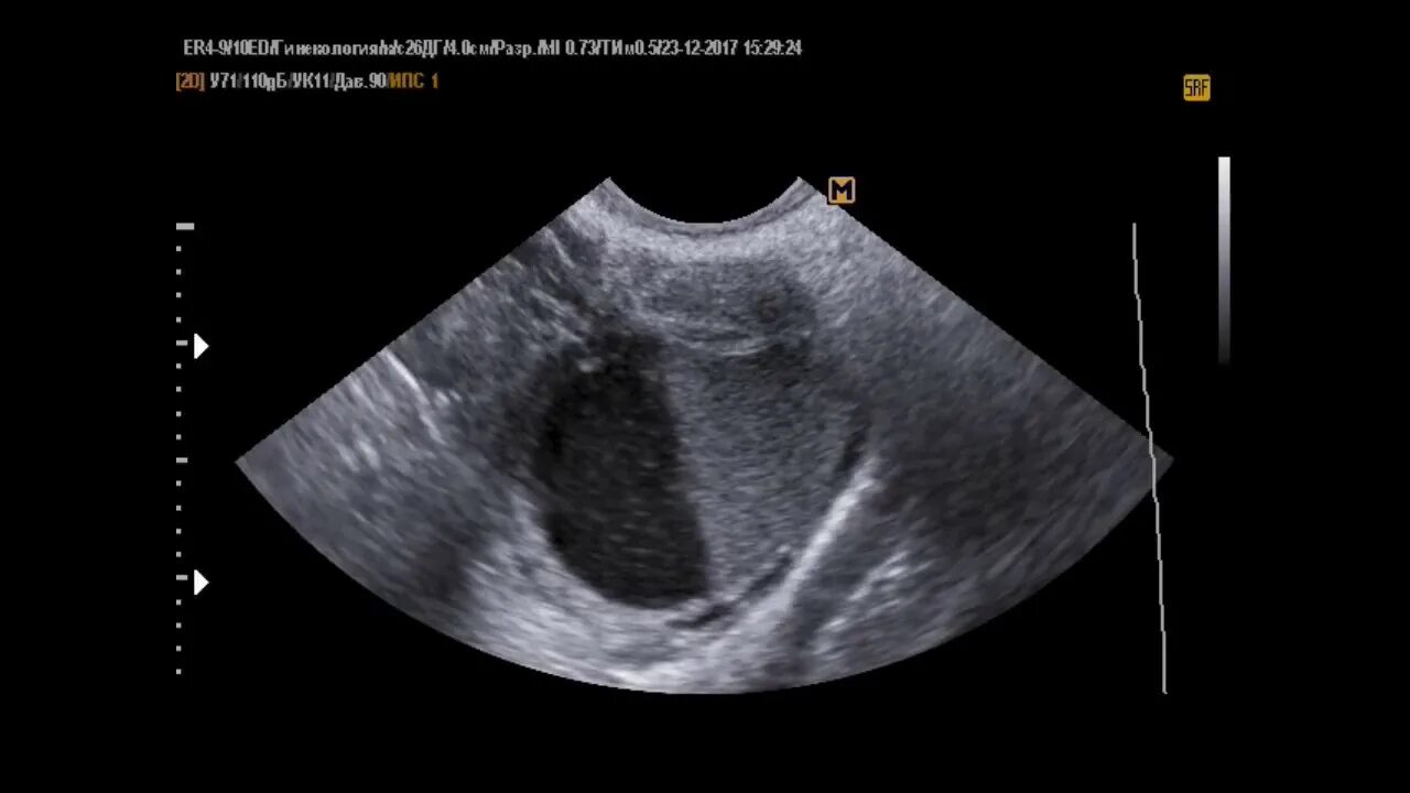 Многокамерная киста яичника на УЗИ. Киста в яичника с пристеночным образованием. Трехкамерная киста яичника. Киста с пристеночным компонентом. Киста яичника с перегородками