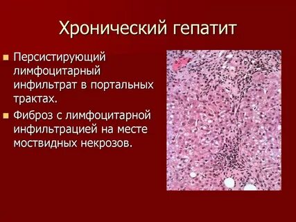 Лимфоцитарная инфильтрация