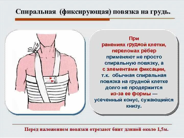 Спиральная повязка на грудную клетку при переломах. При переломе ребер повязку на грудную клетку накладывают в состоянии. Травма грудной клетки перевязка. Спиральная повязка при переломе ребер. Нужно ли перевязывать