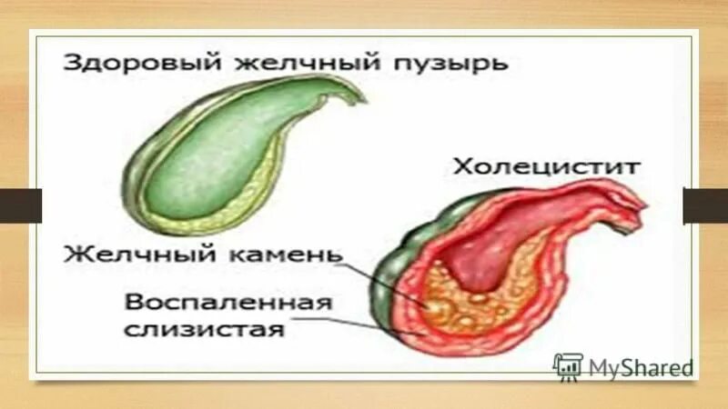 Желчный пузырь у новорожденного. Острый флегмонозный холецистит. Хронический калькулезный холецистит. Бескаменный холецистит. Острое воспаление желчного пузыря.