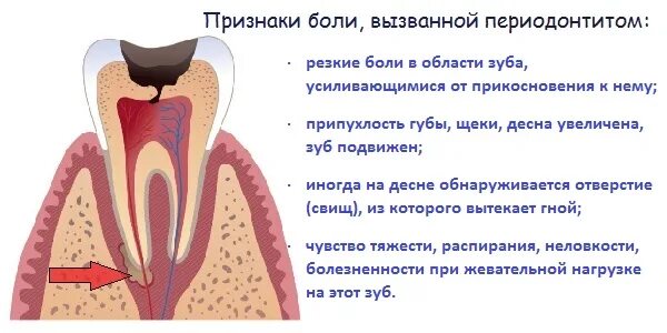 Через сколько зуб перестает болеть. Болит зуб.