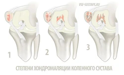 Хондромаляция медиальных мыщелков бедренной кости. Хондромаляция бедренной кости 2 степени. Хондромаляция бедренной кости 3 степени. Хондромаляция надколенника 2-3 степени. Хондромаляция коленного сустава 3 стадия.