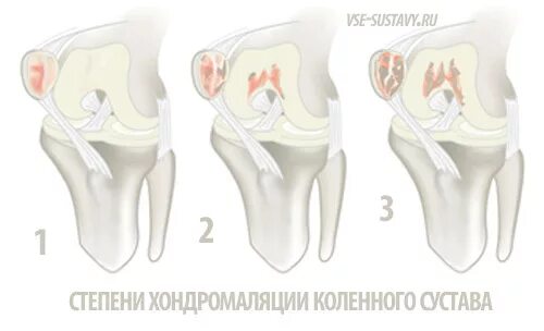 Хондромаляция бедренной кости 2 степени. Хондромаляция бедренной кости 3 степени. Хондромаляция надколенника 2-3 степени. Хондромаляция коленного сустава 3 стадия.