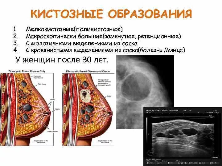 Округлые образования в молочной железе