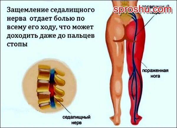 Седалищный нерв где находится симптомы. Седалищный нерв где находится симптомы