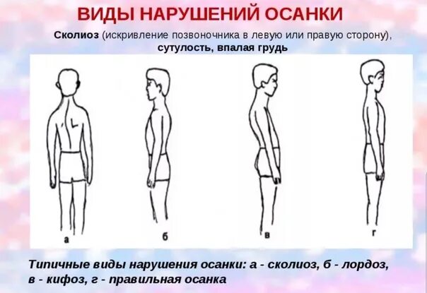 Нарушения и в какую сторону. Симптомы сколиотической осанки. нарушения осанки типы сколиоз. нарушение осанки сколиоз сутулость. лордотический тип осанки.