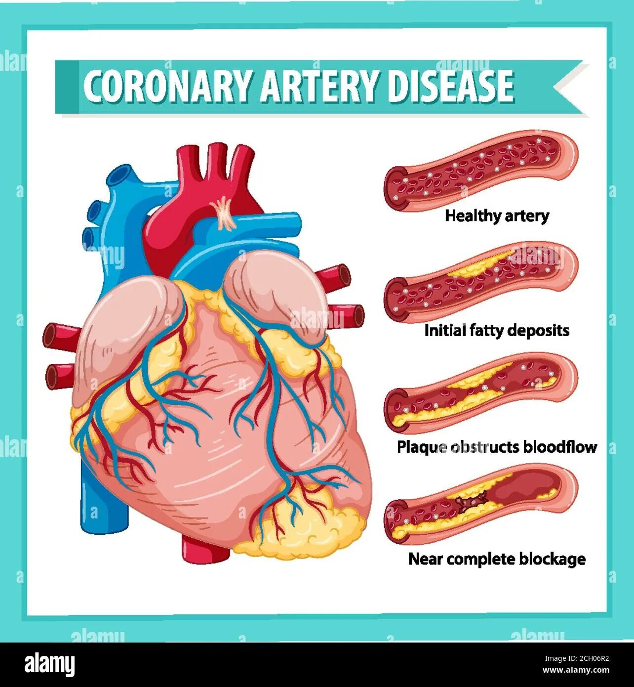 Coronary disease. Coronary disease. Ишемическая болезнь сердца. Ишемическая болезнь сердца. Coronary disease.