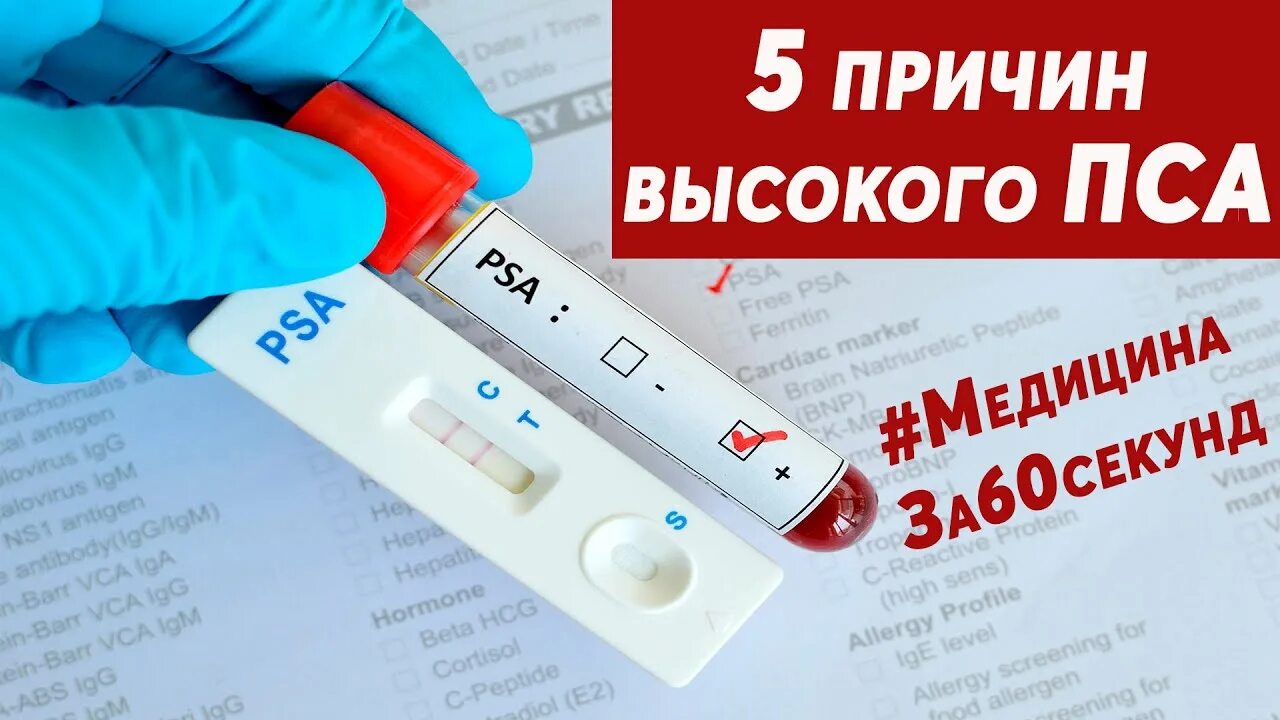 Исследование крови на пса что это такое. Пса урология. Тест крови на пса. Пса крови у мужчин.