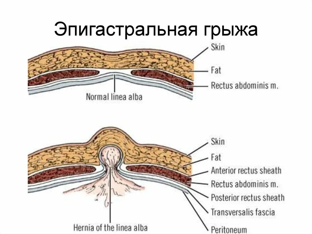 Как узнать грыжа или нет. Гипогастральная грыжа. эпигастральная вентральная грыжа.