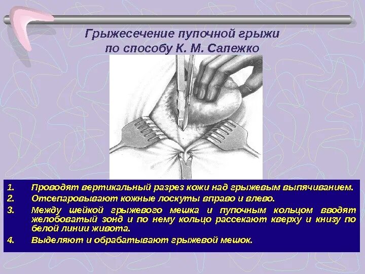 Пупочная грыжа у взрослых код по мкб. Пупочная грыжа операция операция. Операции при пупочных грыжах по Лексеру Мейо Сапежко. Ущемление грыжи пупочной операция.