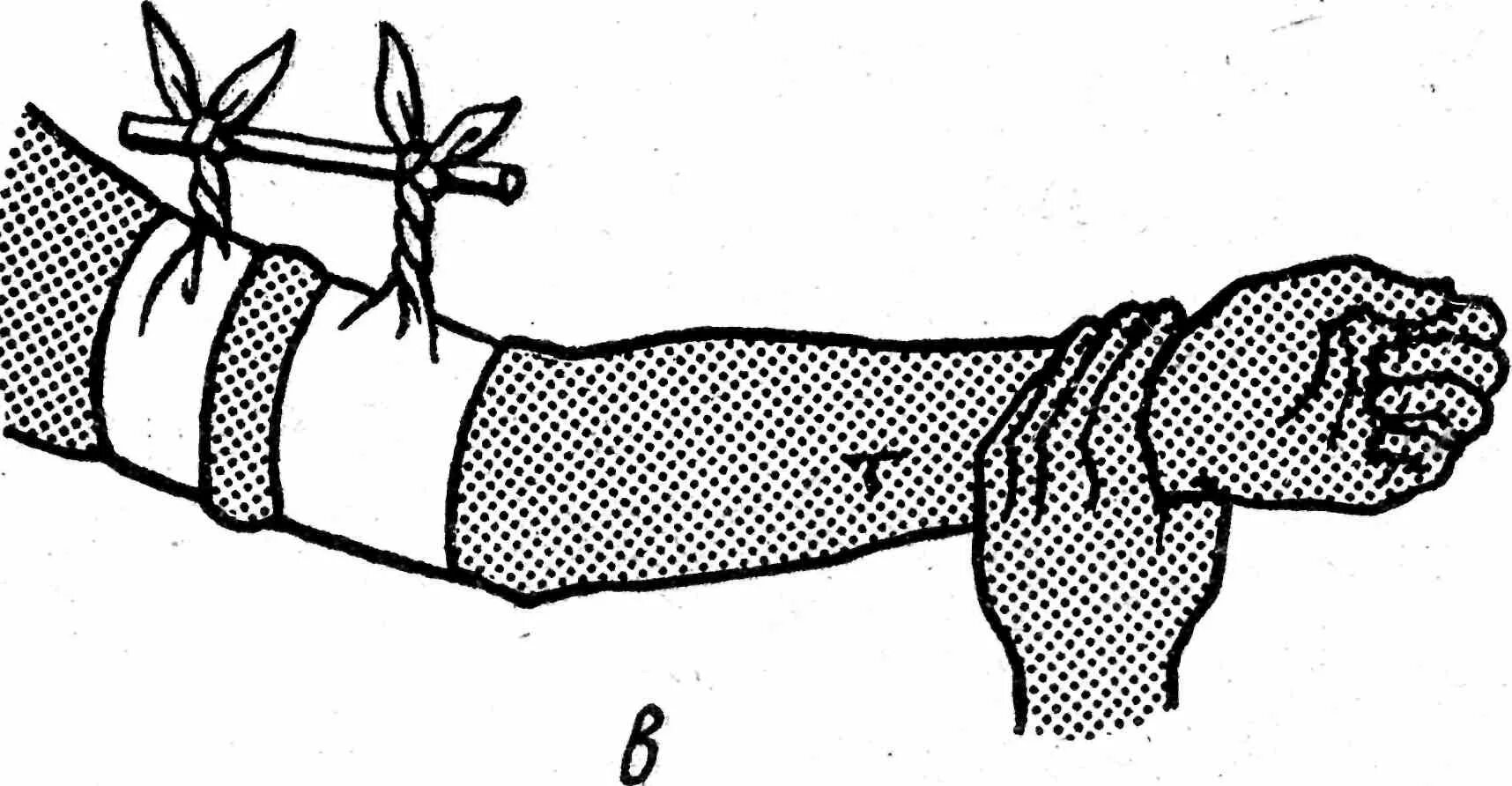 Наложение жгута и повязки. Давящая повязка на область предплечья.