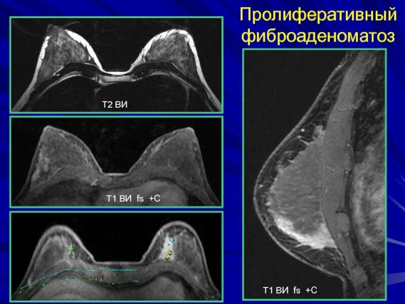 Выраженный диффузный фиброаденоматоз молочных. Диффузного фиброаденоматоза мрт. мрт молочных желез фиброаденоматоз. фиброаденоматоз молочной железы мрт.