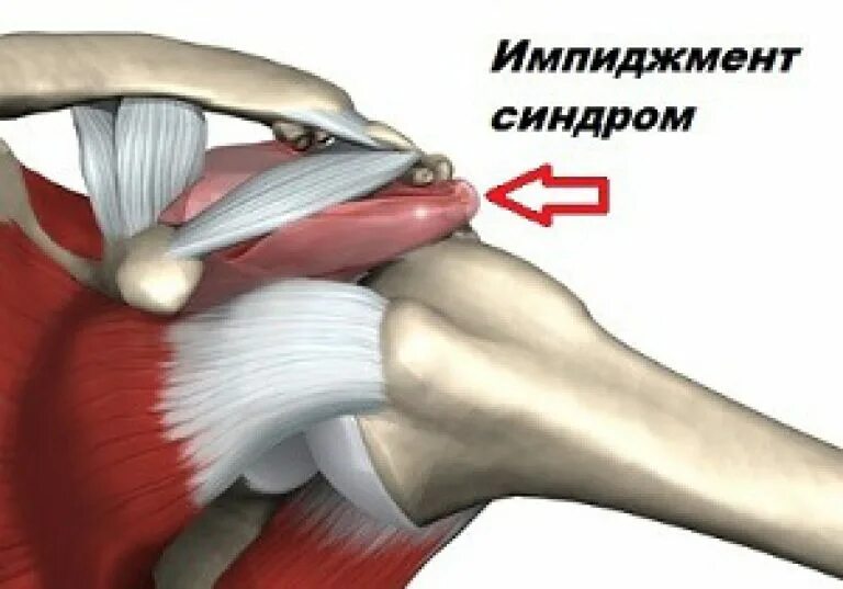 Субакромиальный импинджмент синдром. Импиджмент синдром плеча. Импинджмент надостной мышцы. Импинджмент сухожилия надостной мышцы.