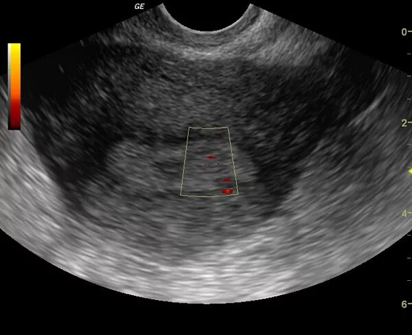 Допплерометрия сосудов эндометрия. Допплерография сосудов матки на УЗИ. Полип эндометрия на УЗИ малого таза. Кровоток в полип эндометрия УЗИ. Эндометрия скудная