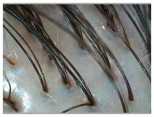 A) The anagen hair root is covered by a long sheath. (B) The telogen... Download
