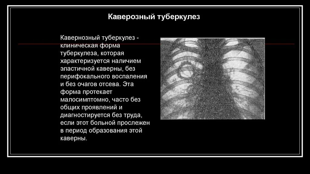 Перифокальное воспаление. Инфильтративный туберкулез патогенез. Перифокальная инфильтрация это. Влажные хрипы, притупление перкуторного звука. Перифокальная инфильтрация это.