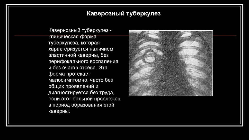 Без перифокальной реакции. Перифокальное воспаление. Кавернозный туберкулез клиника. Туберкулёзная каверна. Перифокальное воспаление в легком это.