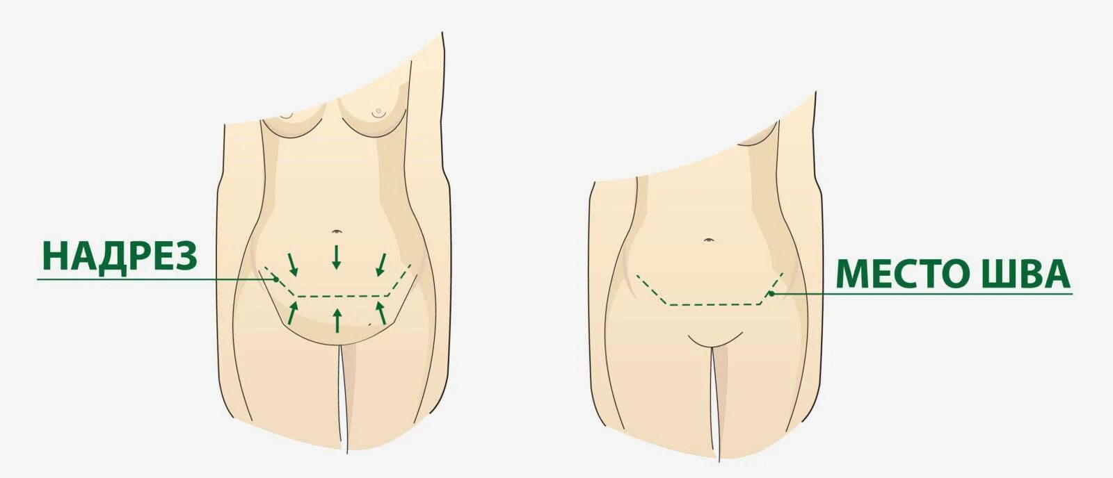 Абдоминопластика схема. Абдоминопластика разрез. Абдоминопластика схема операции. Операция на животе называется