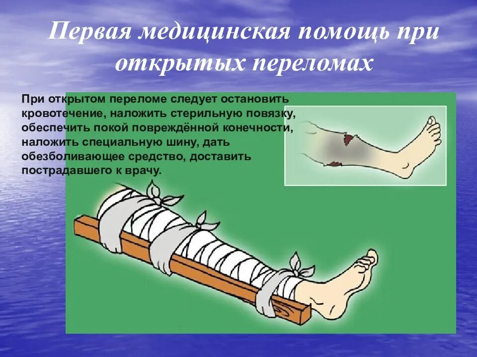 Наложение шины при переломе. При переломах костей конечностей накладывается шина:. при переломе костей голени шира накл. накладывание шины при переломе костей конечностей. наложение шины при открытом переломе.