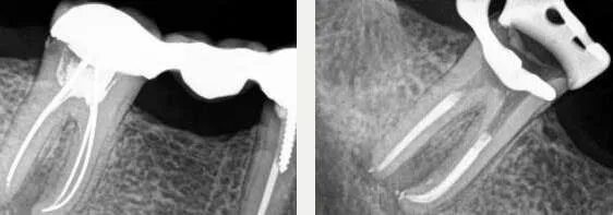 Распломбировка каналов зуба. Стекловолоконный штифт на рентгене. Стекловолоконный штифт на кт. Ультразвук эндодонтии ультразвук. Стекловолоконный штифт в зубе рентген.