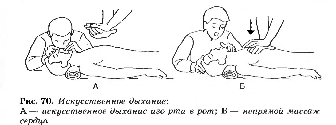 Как делать искусственное дыхание и непрямой массаж. Приемы искусственного дыхания и непрямого массажа сердца. искусственное дыхание и непрямой (наружный) массаж сердца.. искусственное дыхание и непрямой массаж сердца рисунок. искусственное дыхание и непрямой массаж техника выполнения.