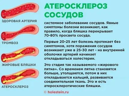 Атеросклероз суставов головного мозга мкб 10. Атеросклероз суставов головного мозга мкб 10