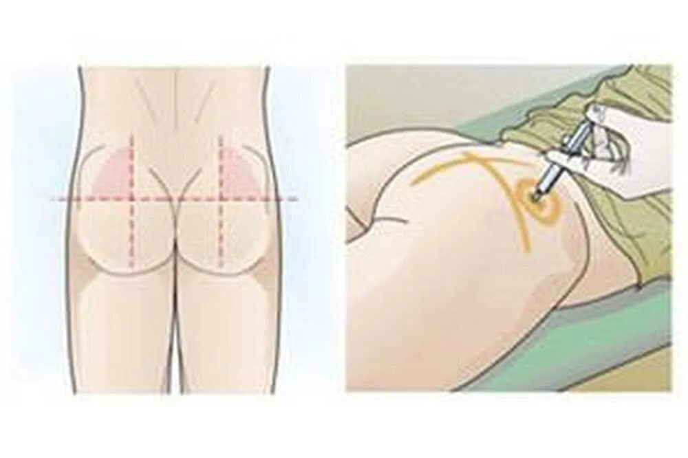 техника выполнения внутримышечной инъекции в ягодицу. как правильно сделать укол внутримышечно. укол в верхний наружный квадрант ягодицы. как правильно сделать укол внутримышечно. как правильно колоть уколы внутримышечно в ягодицу.