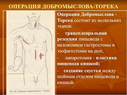Хирургия пищевода