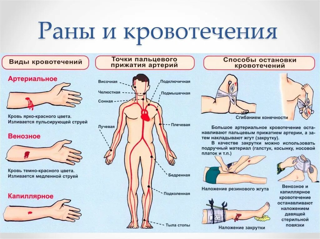 Кровотечения. Раны. Классификация. Первая помощь.. Классификация кровотечения виды способы остановки кровотечения. Вид кровотечения признаки способы остановки. Что такое кровотечение кратко