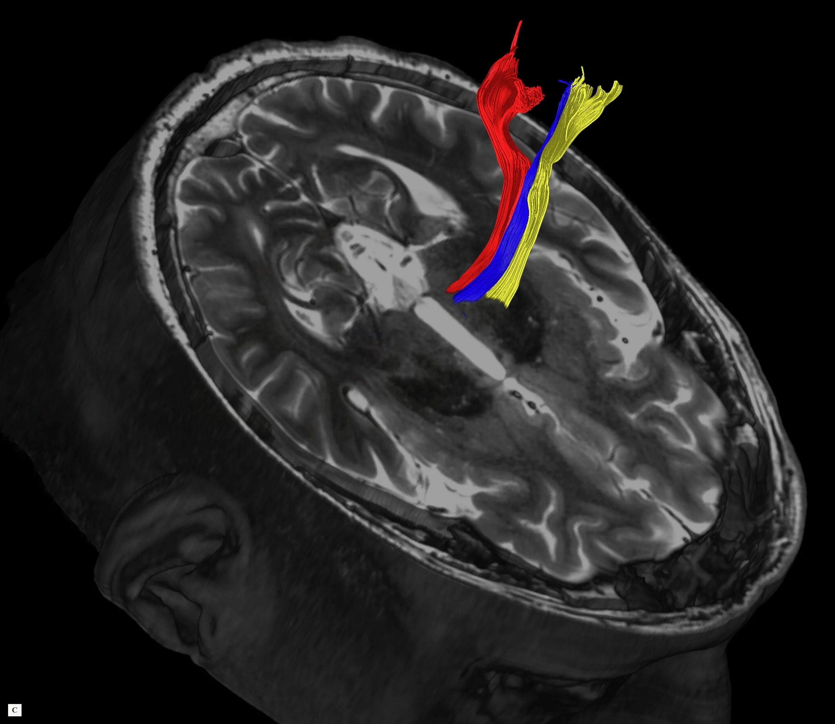 Что находит мрт. Magnetic resonance imaging (mri). мрт мозга. мрт+трактография головного и спинного мозга. цветной мрт головного мозга.