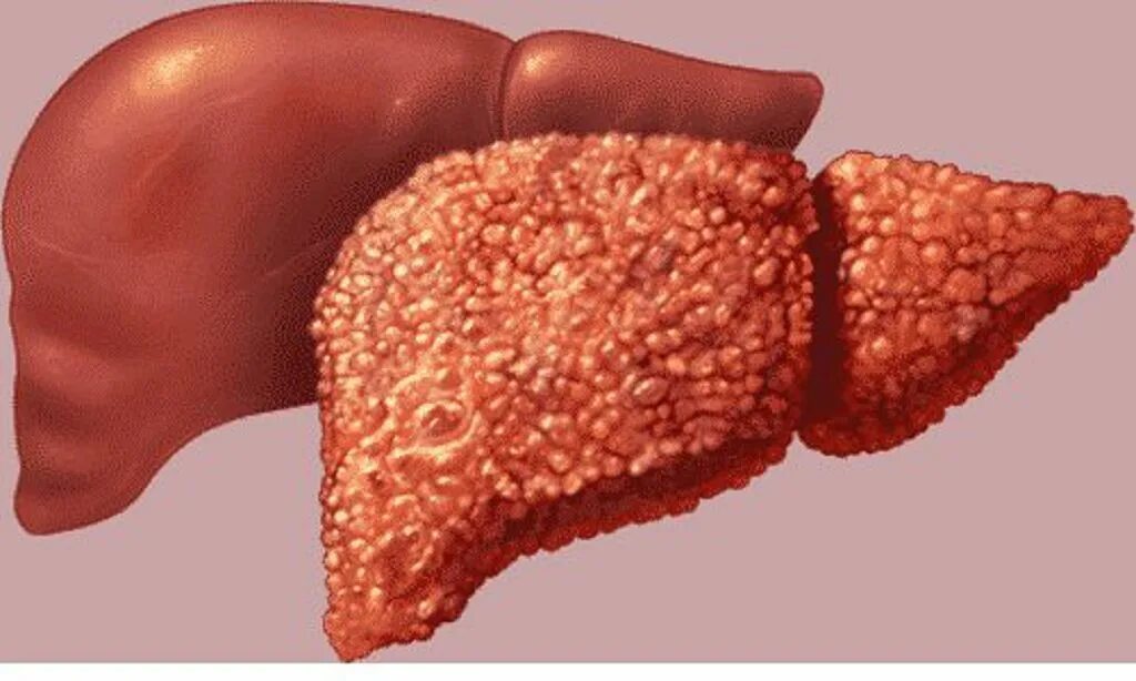 Заболевание печен. Отмирание клеток печени. Некротический цирроз печени. Гепатит б цирроз печени.