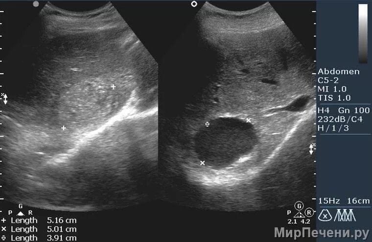 Киста печени причины возникновения у женщин. Киста печени УЗИ признаки. Лимфангиома селезенки. Эхинококковая киста печени УЗИ.