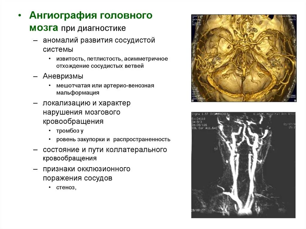Сосудистая аномалия. Пороки развития сосудов головного мозга. Аномалии развития сосудов головного мозга. Пороки формирования головного мозга. Аневризма головного мозга.