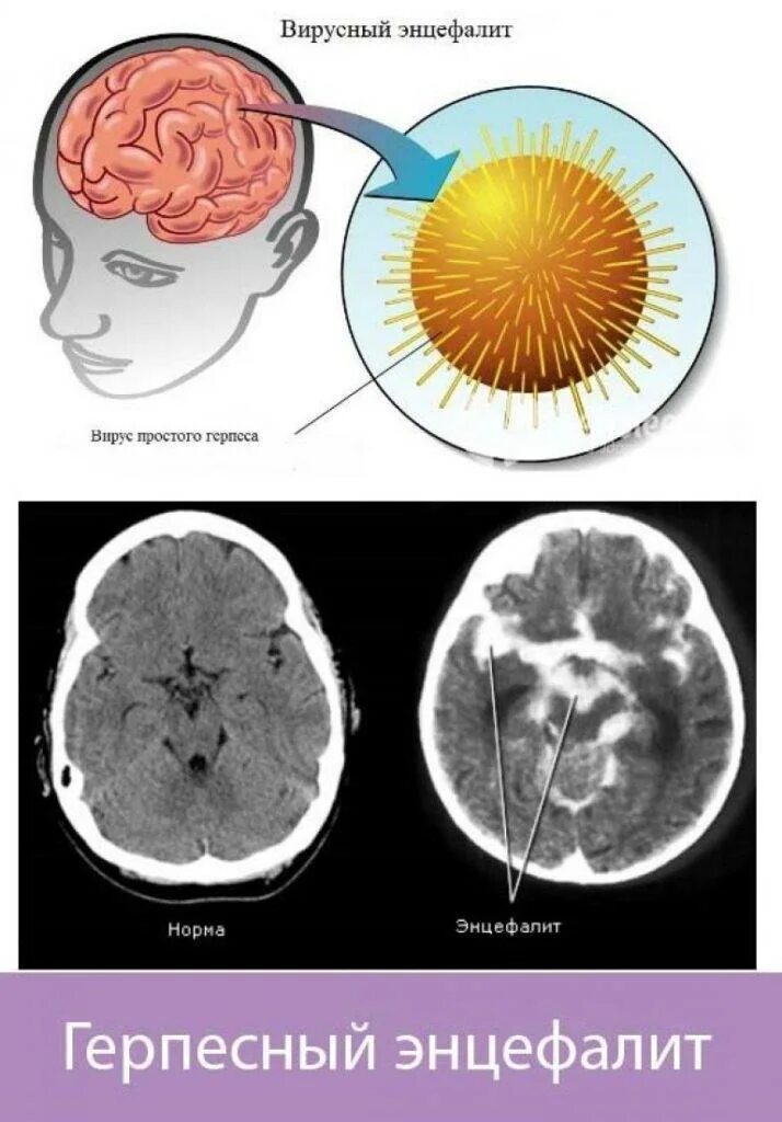 Инфекционные поражения мозга. Герпетический энцефалит. Менингит энцефалит и менингоэнцефалит. Энцефалит воспаление головного мозга.