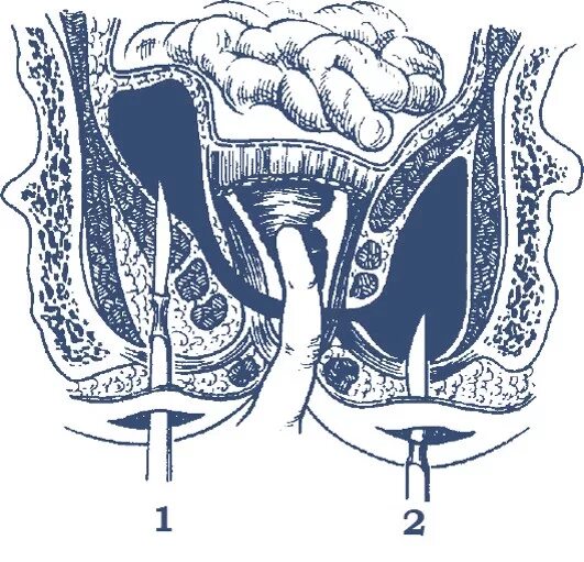 Острый ишиоректальный парапроктит. Пельвиоректальный парапроктит. Подкожный парапроктит. Ишиоректальный парапроктит вскрытие.