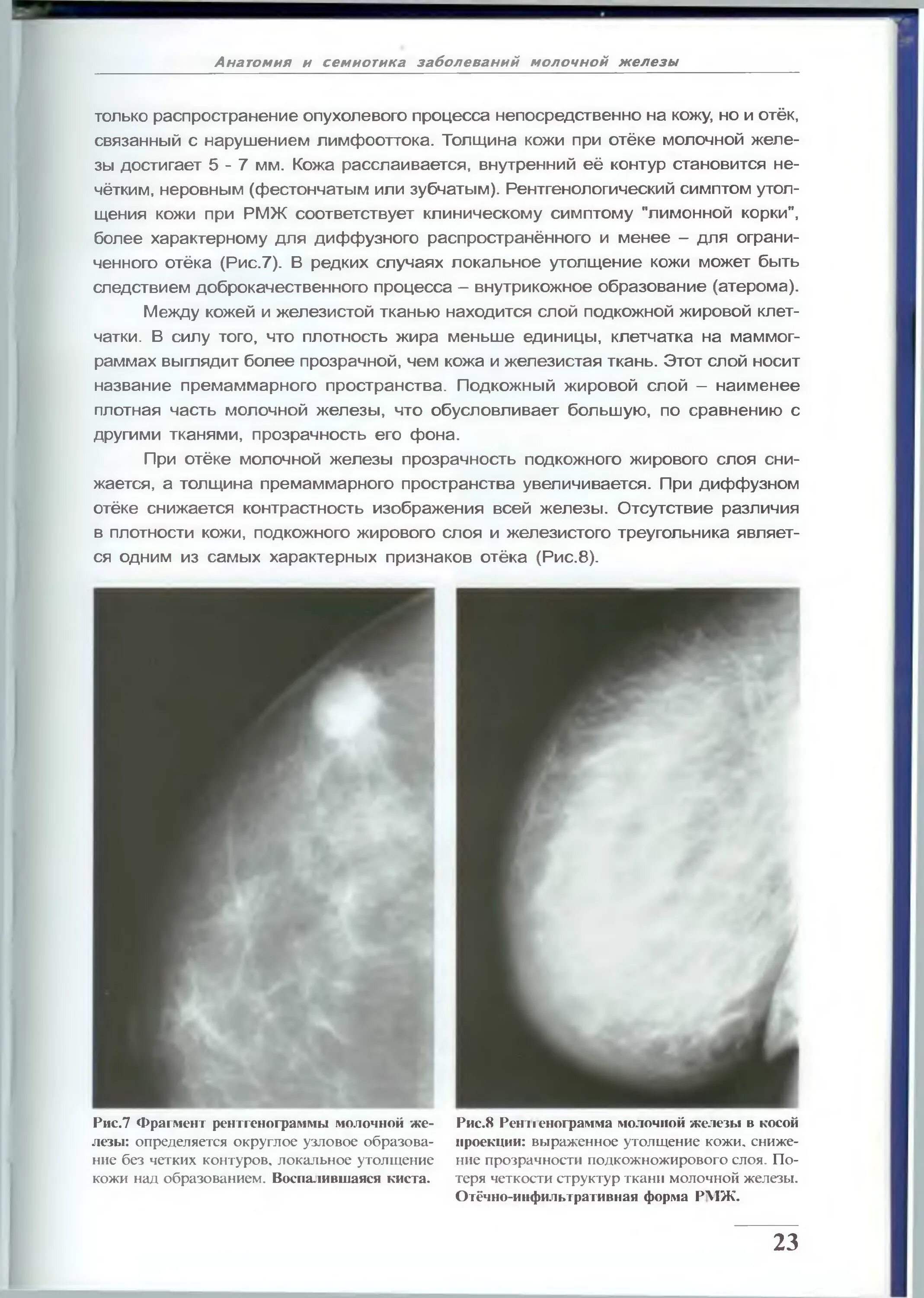 Маммография книга. Атлас по маммологии. Маммограмма молочных желез норма. Маммография в двух проекциях. Маммография в двух проекциях.