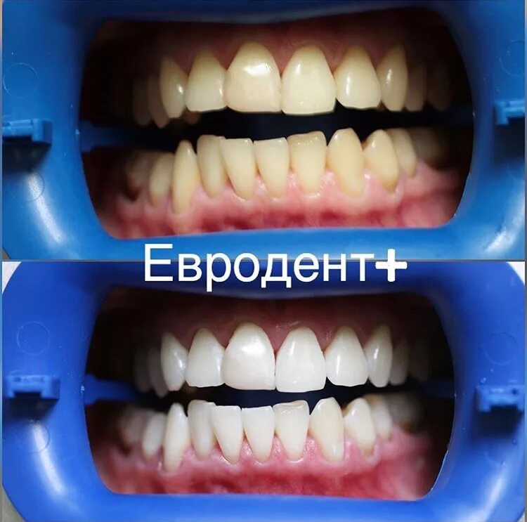 Отбеливание зубов иркутск. Отбеливание зубов. Отбеливание зубов до и после. Лазерное отбеливание зубов.