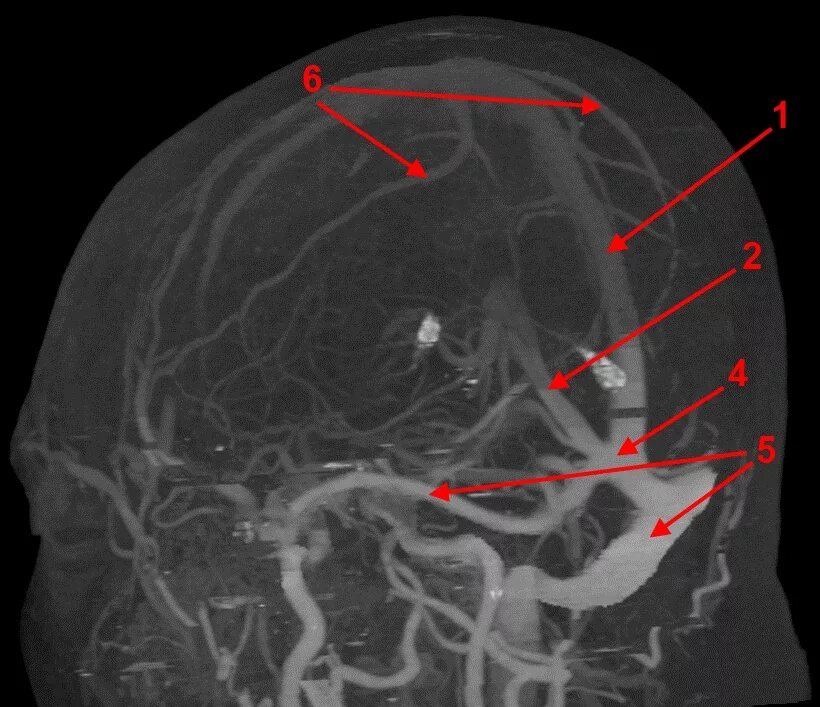 Тромбоз сигмовидного синуса на кт. Тромбоз Вена Галена кт. Тромбоз сагиттального синуса мрт. Вена Галена мрт анатомия. Тромбоз артерий мозга