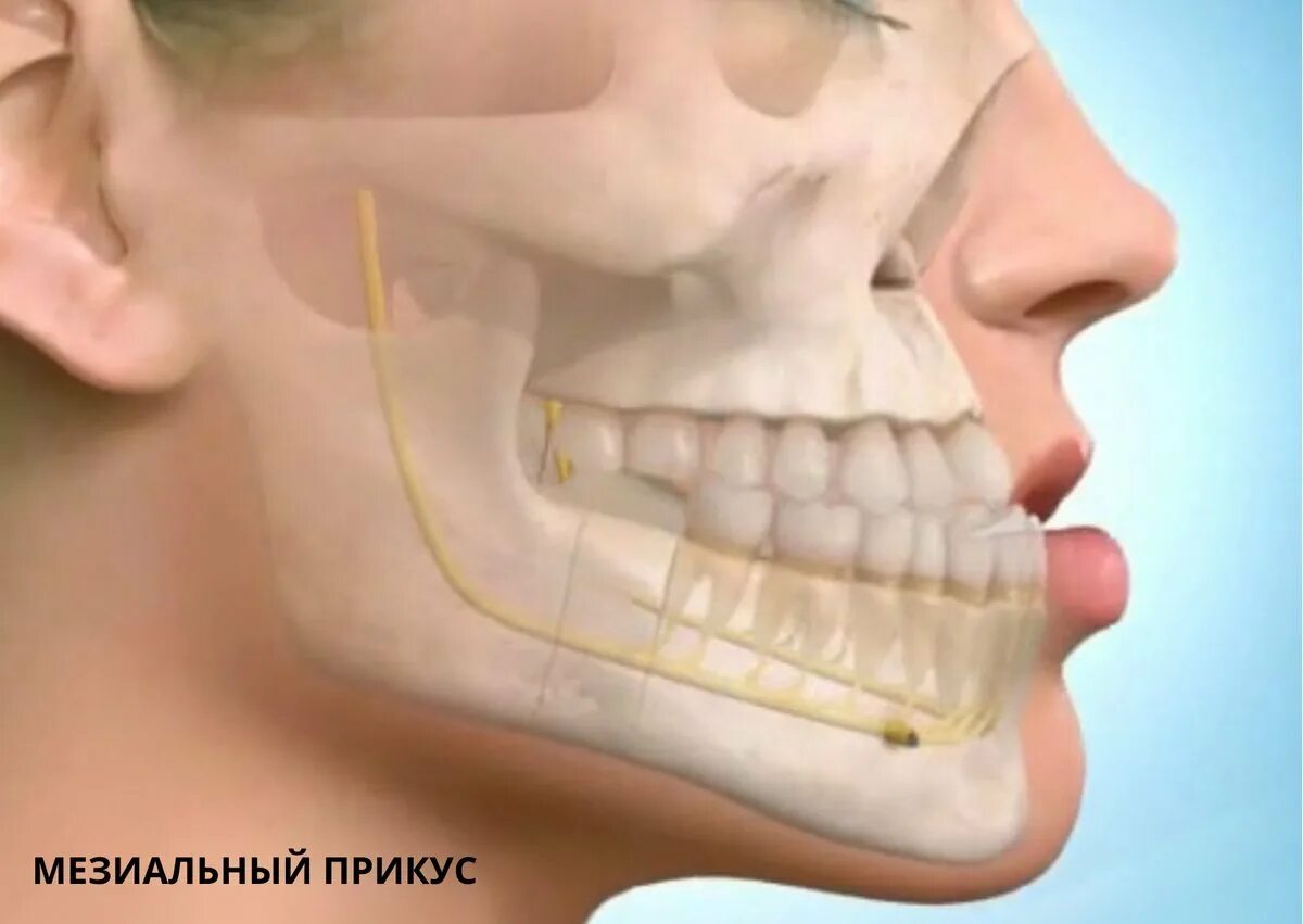 Зубы при закрытом рте. Мезиальный прикус нижней челюсти. (Прогенический мезиальный прикус). Мезиальный прикус челюсть. Мезиальный прикус операция.