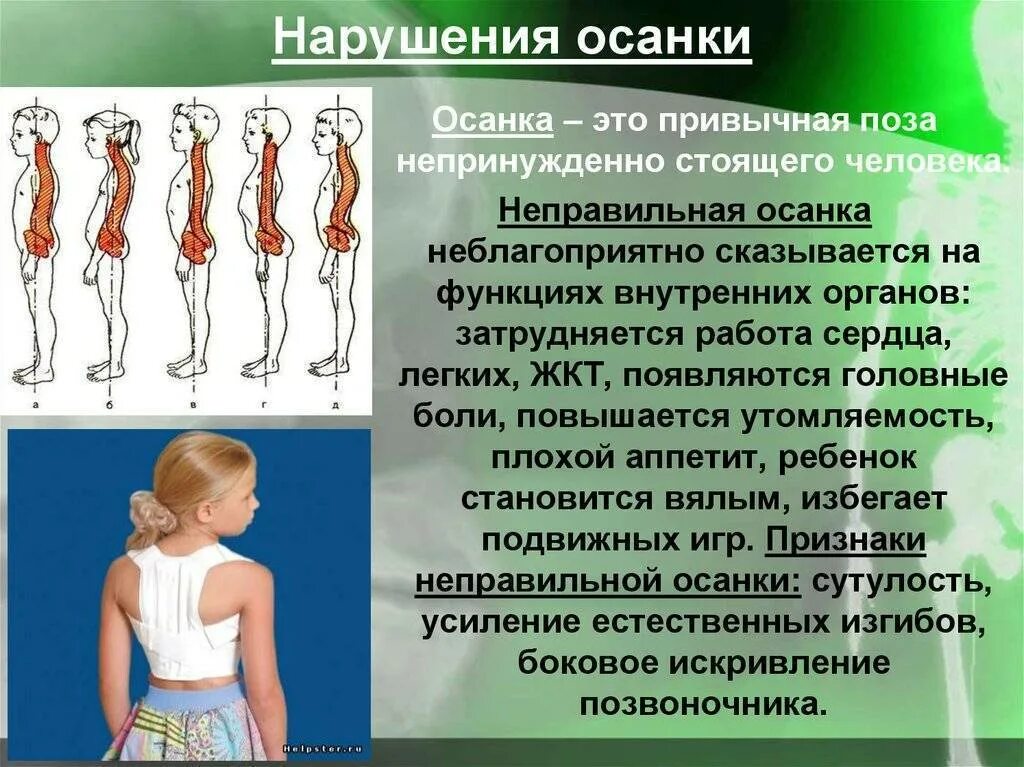 Нарушения осанки возникают. Нарушение осанки. нарушения осанки у детей. формирование неправильной осанки. причины нарушения осанки.