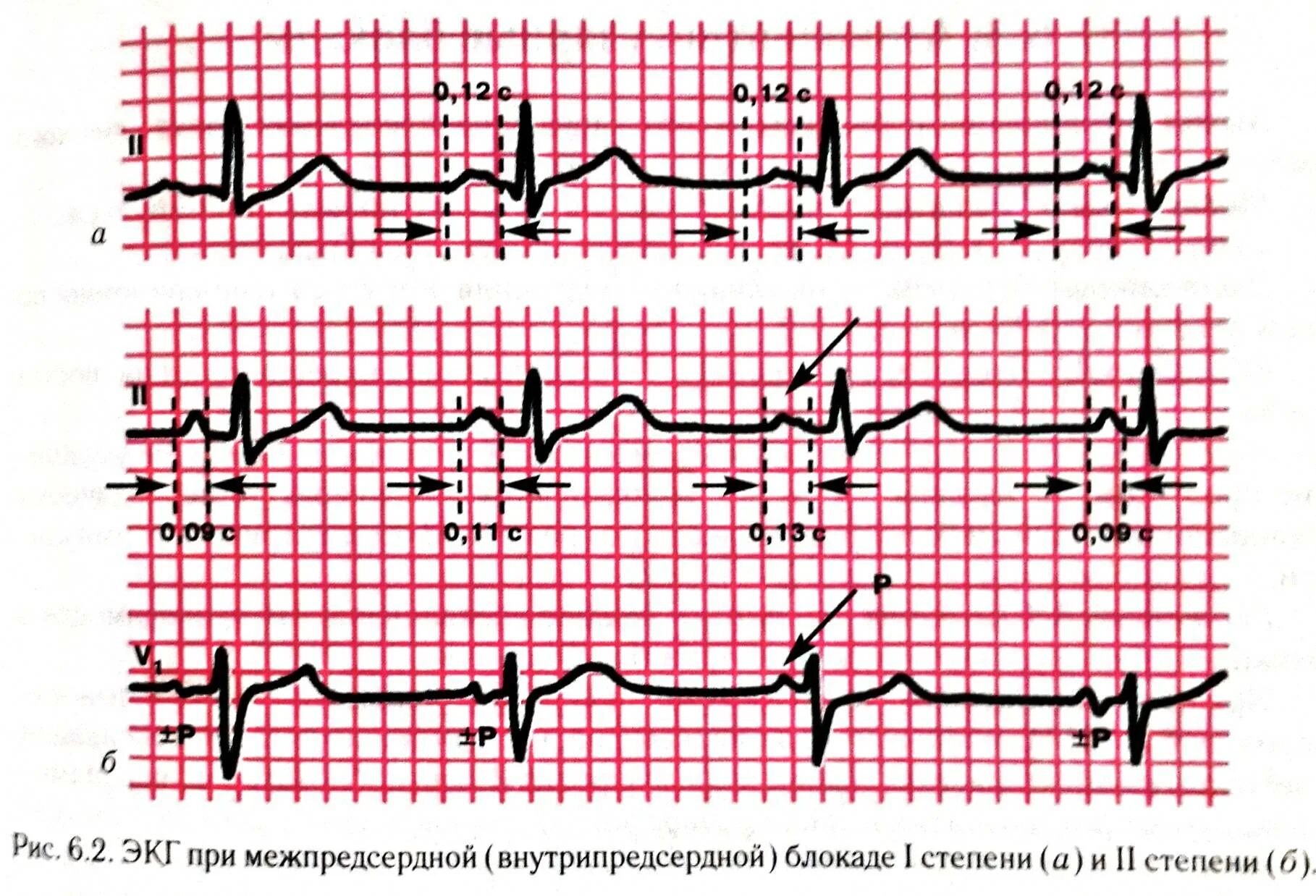 Что значит внутрипредсердная внутрипредсердная блокада. Внутрипредсердная блокада 3 степени ЭКГ. ЭКГ при внутрипредсердной блокаде. Межпредсердная блокада 2 степени ЭКГ. Полная межпредсердная блокада на ЭКГ.