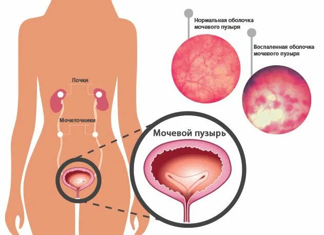 После мочевого. Цистит причины возникновения. Цистит клиника. Посткоитальный цистит у женщин.